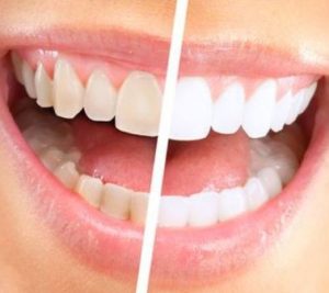 Blanchiment des dents - Dentisterie