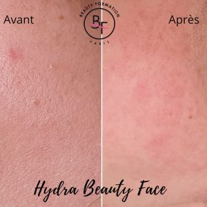 Front - Peau