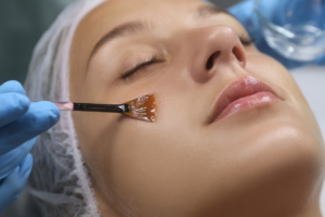 peeling chimique entier peeling chimique visage entier