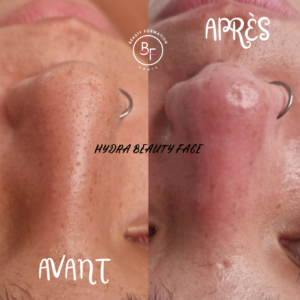 Hydra beauty face avant après