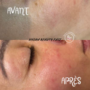 avant après hydra beauty face