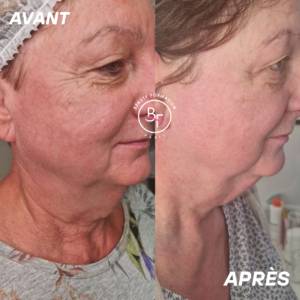 Avant Après radio fréquence